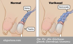 Çocuklarda Varikosel Nedir? Varikosel Belirtileri ve Tedavisi