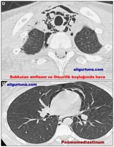Çocuklarda Spontan Pnömomediastinum 1 Çocuklarda Spontan Pnömomediastinum 1