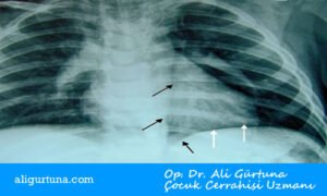 Çocuklarda spontan mediastinum akciğer grafisi Çocuklarda spontan mediastinum akciğer grafisi