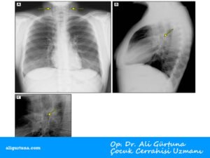 Çocuklarda spontan mediastinum akciğer grafisi: Çocuklarda spontan mediastinum akciğer grafisi: