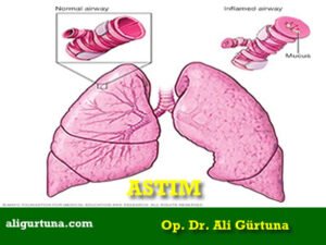 Astım Nedir? Astım Belirtileri, Nedenleri ve Tedavisi